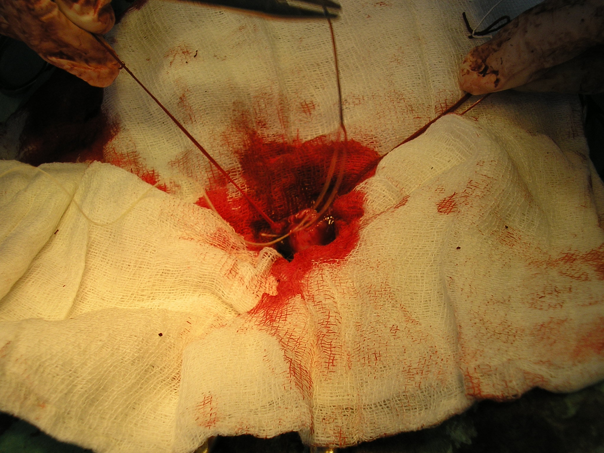 изоляция шейки матки от окружающей брюшной полости при овариогистероэктомии